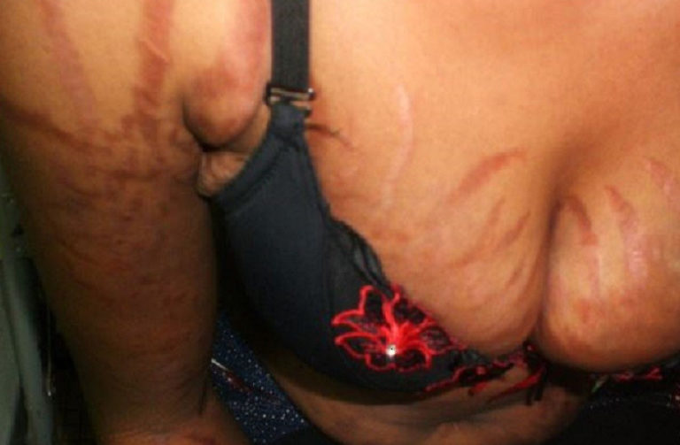 Dépigmentation à l’injectable: Incursion dans un trafic de corticoïdes