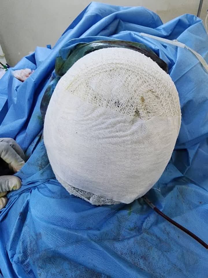 Ouahigouya : La patiente dont une pioche a été retirée de la tête va mieux